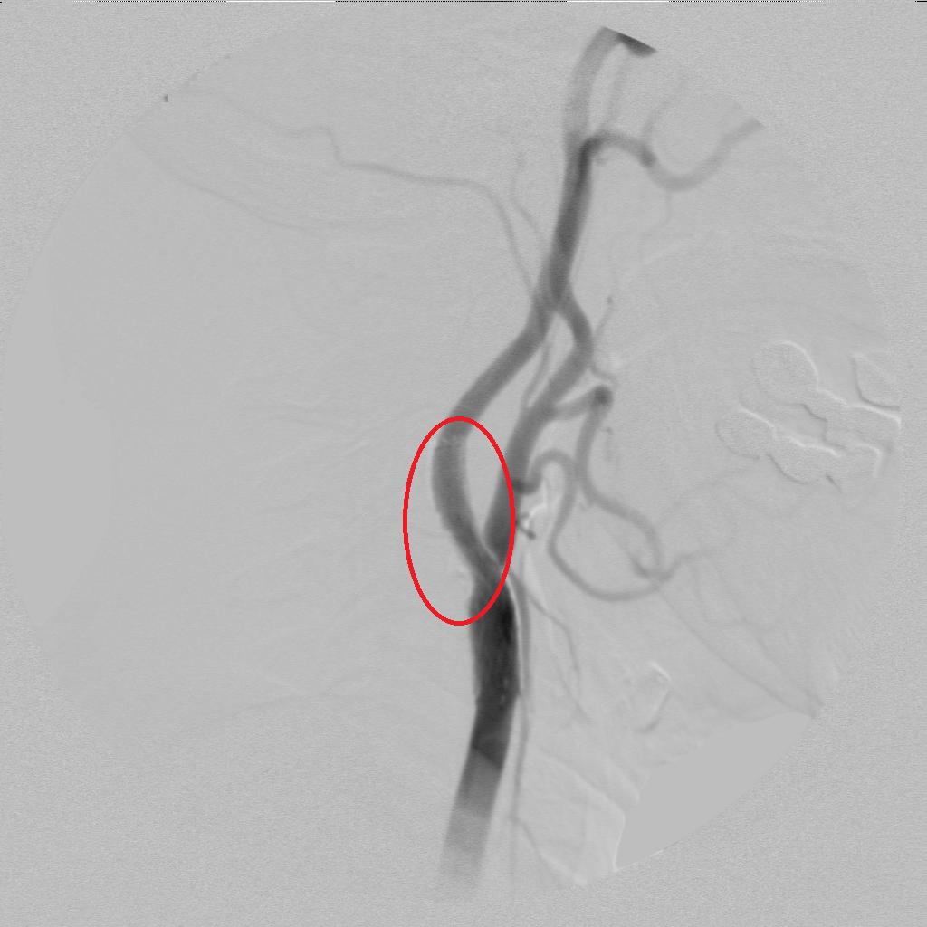 脑卒中超早期康复科普,1分钟了解脑梗