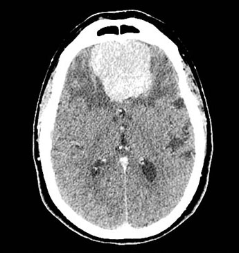 脑膜瘤有些什么症状,脑膜瘤症状有哪些啊