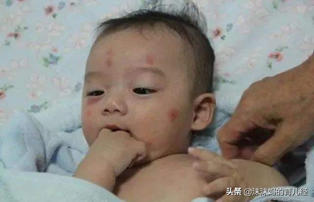 宝宝被蚊子叮咬后红肿是什么原因,宝宝被蚊子叮咬红肿特别大怎么办
