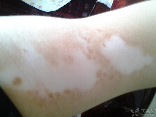 小心盆栽：女子白癜风恶化，表妹送的乔迁礼成罪魁祸首