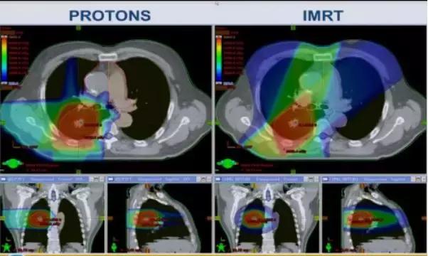 质子治疗适用于什么癌症,质子治疗癌症的疗效咋样