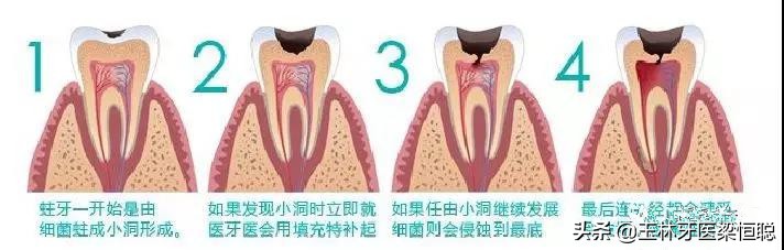 牙坏了医生说保不住为什么不给拔,牙崩了一半怎么补牙