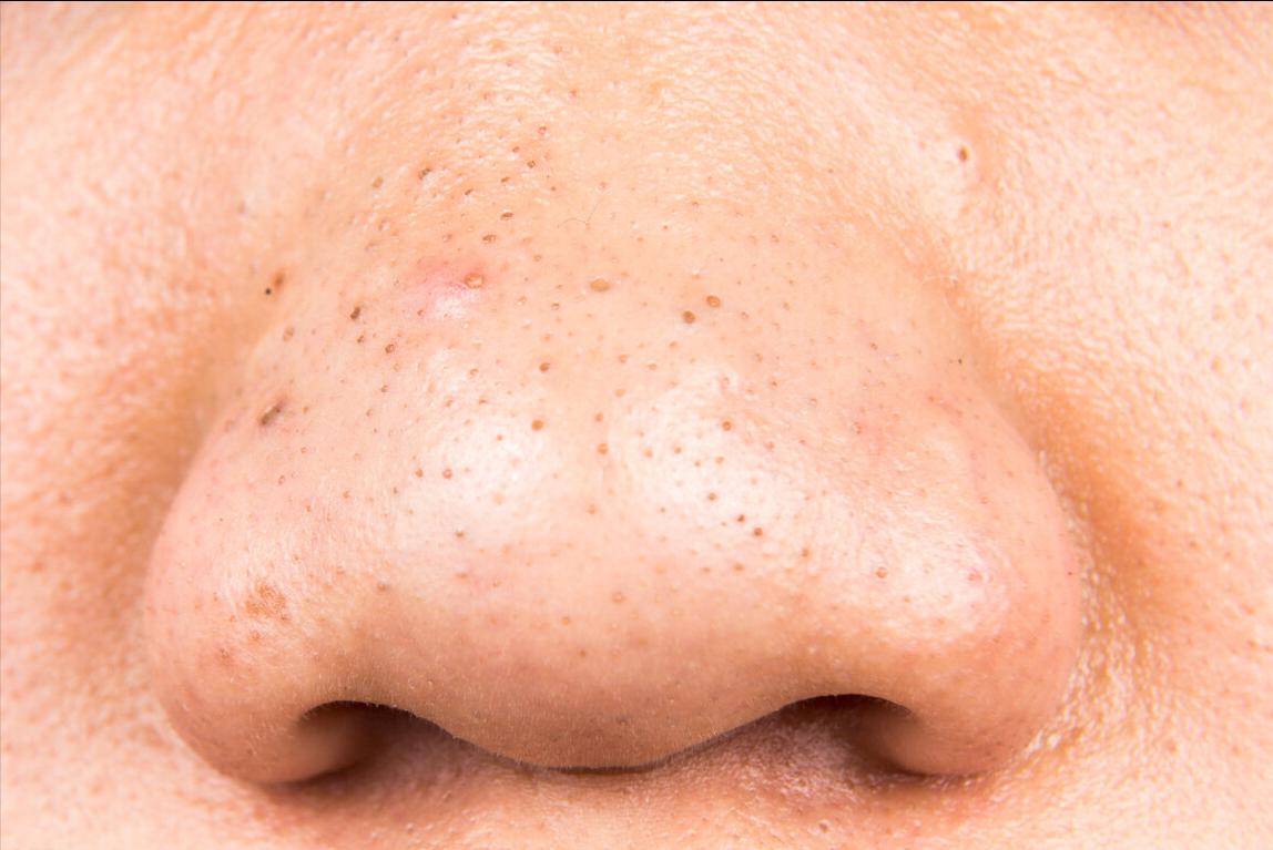 鼻子上的黑头怎么去掉小妙招13岁,鼻子上的黑头怎么去掉学生