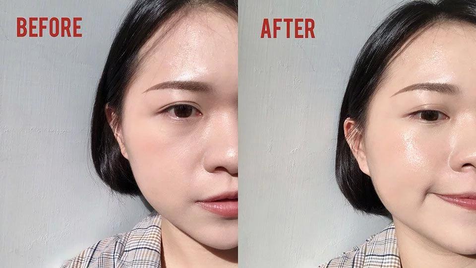 夏季起粉刺痘痘怎么调理,夏天为什么痘痘肌更容易长痘了