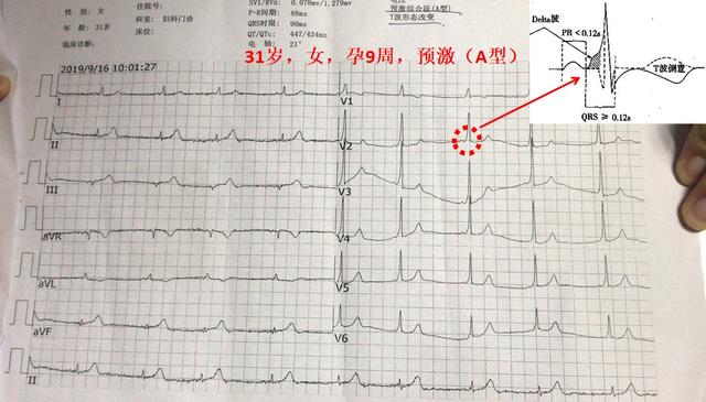 怀孕了心脏发慌是怎么回事,怀孕了心脏经常突然抖一下