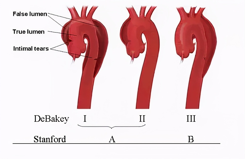 高血压引起的动脉夹层破裂死亡,高血压引起的主动脉夹层抢救