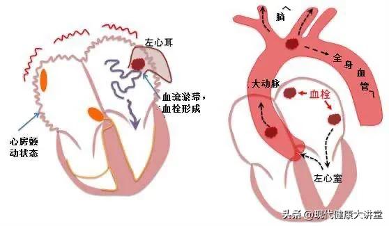 心房颤动的症状,心房颤动的临床特点