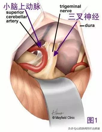 长治市和平医院能做减压手术吗,长治市和平医院动脉介入手术