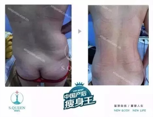 生育损害,生育后做哪些产后修复