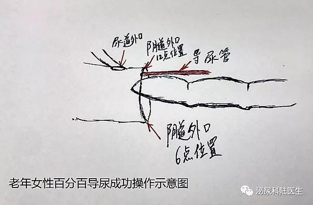 科普|老年女性百分百成功导尿秘笈来喽