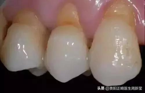 牙疼牙酸怎么治疗,牙疼了补牙来不及吗