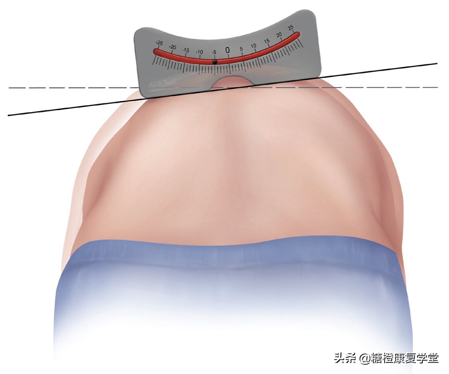 最常见的脊柱侧弯，这样运动治疗，效果明显