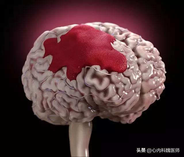 高血压脑出血急救护理ppt,高血压脑出血晕倒一小时急救