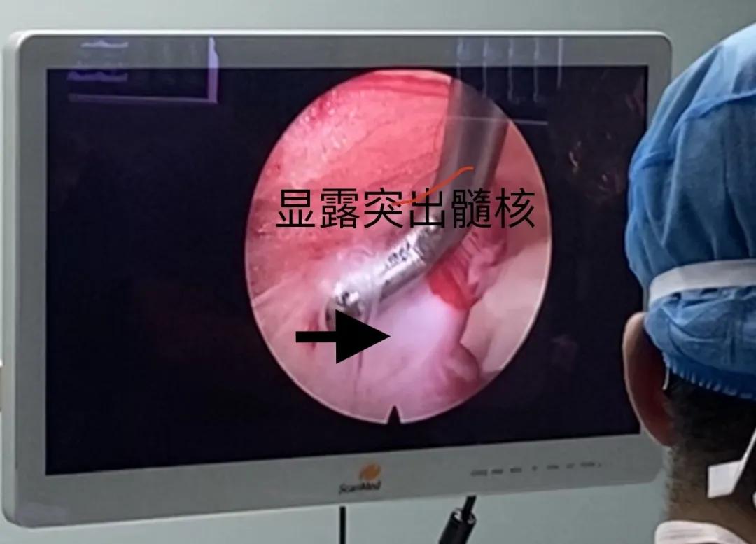 渭南治腰间盘突出哪家最好,脊柱神经外科手术