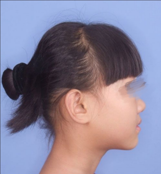 正畸初诊治疗需要验血吗,正畸初诊到戴牙套多久