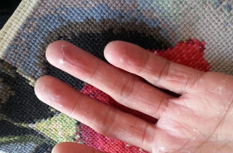 孩子手脚干燥脱皮发红怎么回事,小孩手脚脱皮是什么原因怎么治