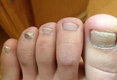 娃指甲上有白点是怎么回事,孩子指甲横纹有白点