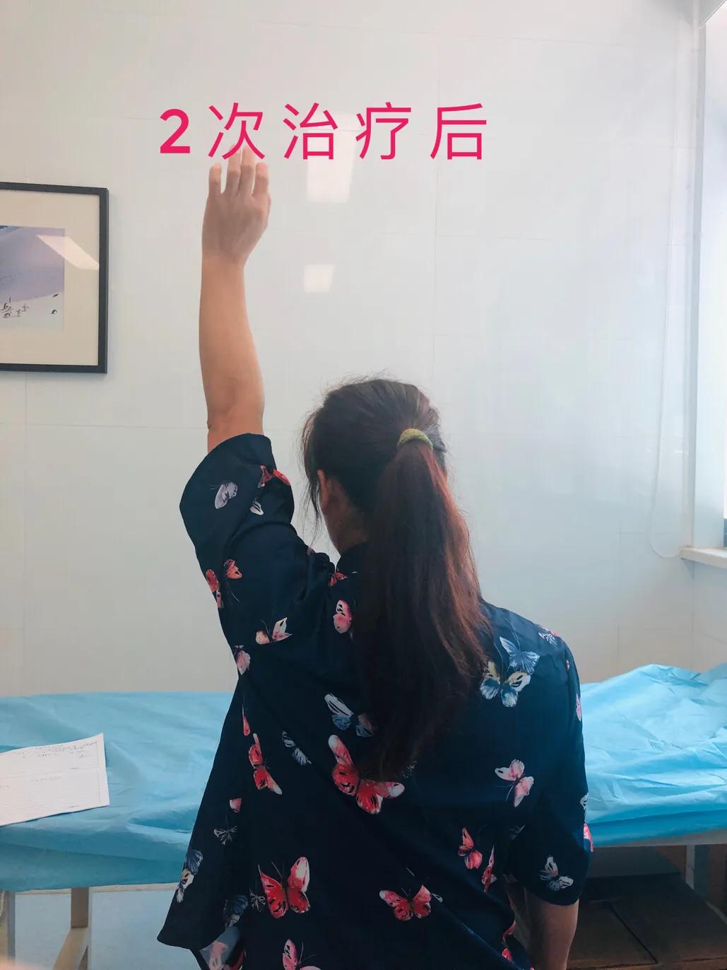 肩周炎指南最新,医生谈肩周炎