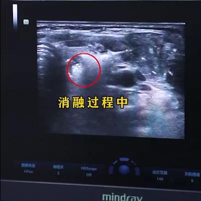 桥本轻微甲亢,桥本甲亢5年还没好