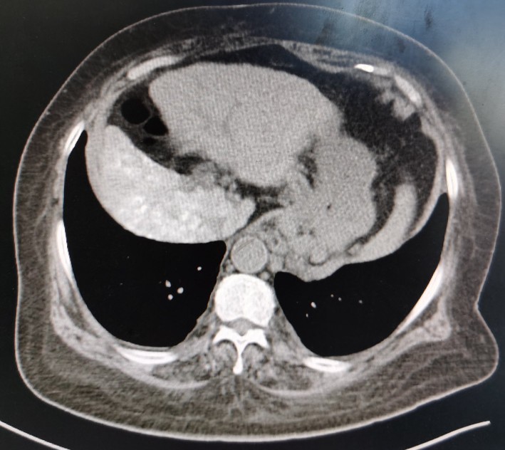 黄婶的肝癌用介入治疗已经3年多了-适合自己的治疗才是最好的治疗