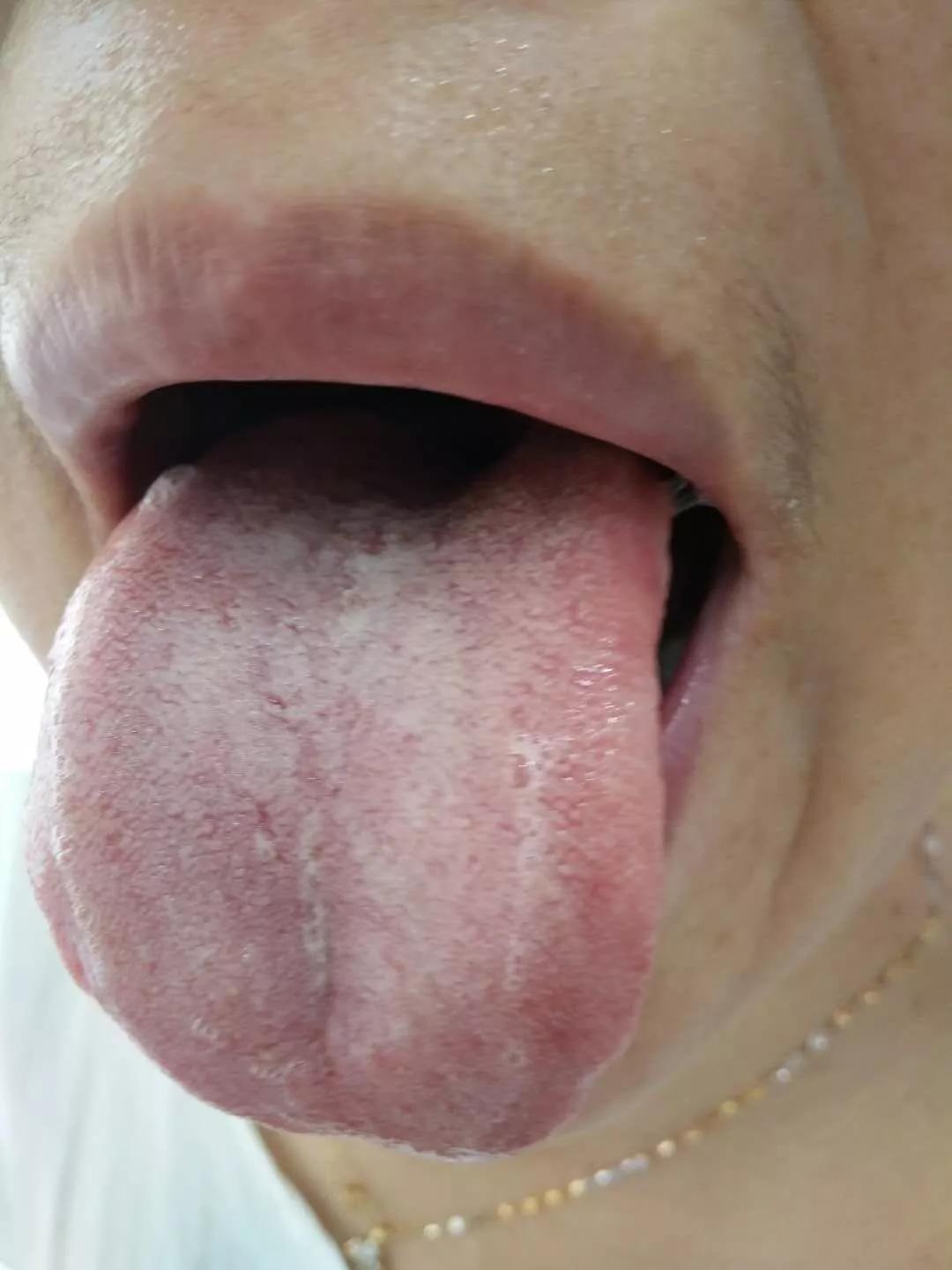 中医治疗更年期潮热汗出的三种思路（其三）