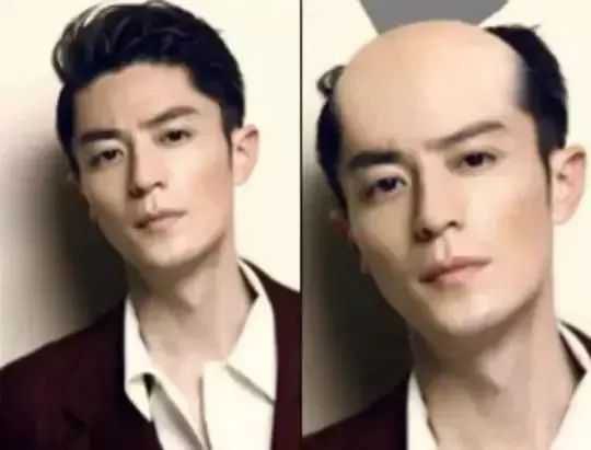 有了这个神器,英国人的脱发有救了?