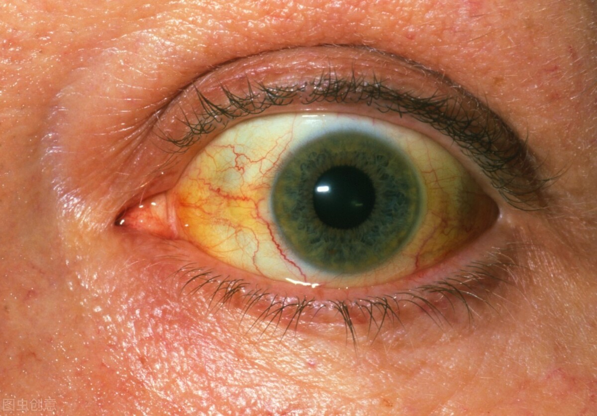 转氨酶胆红素都高伴有黄疸严重吗,转氨酶高必须要吃保肝药吗