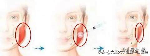 爱美变美小知识,爱美除皱针效果怎么样