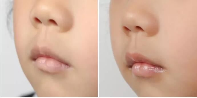 小孩长期嘴唇干裂起皮还出血,儿童嘴唇起皮干裂出血怎么办