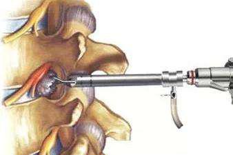 椎孔镜技术治疗颈椎间盘突出,椎间孔镜前沿技术