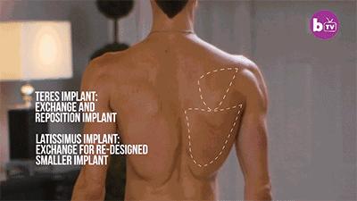 关于隆胸手术你想知道的那些事,隆胸丰臀整形