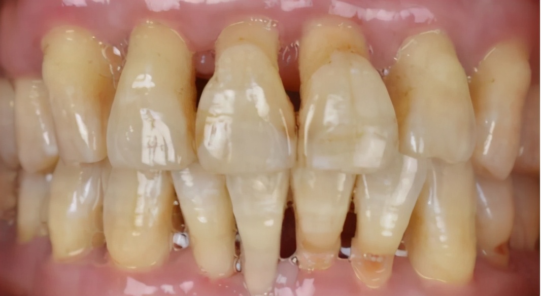 十八岁是矫正牙齿好还是烤瓷牙好,牙齿中线不齐能通过烤瓷牙修复吗