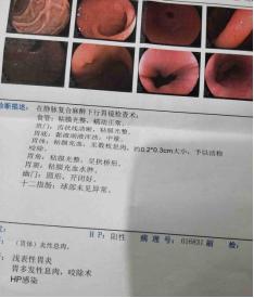 经常胃反酸呕吐螺旋杆菌阳性,幽门螺旋杆菌阳性出现胃酸胃胀