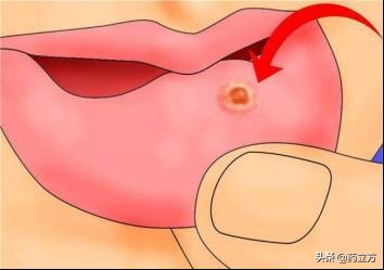 口腔溃疡长期不好是口腔癌吗,口腔溃疡一直不好是口腔癌吗