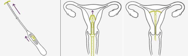 上环曼月乐起避孕效果吗,痛经上环避孕哪种好