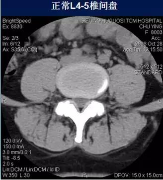 腰椎退行性变腰椎间盘轻度突出,椎间盘突出并膨出继发椎管狭窄