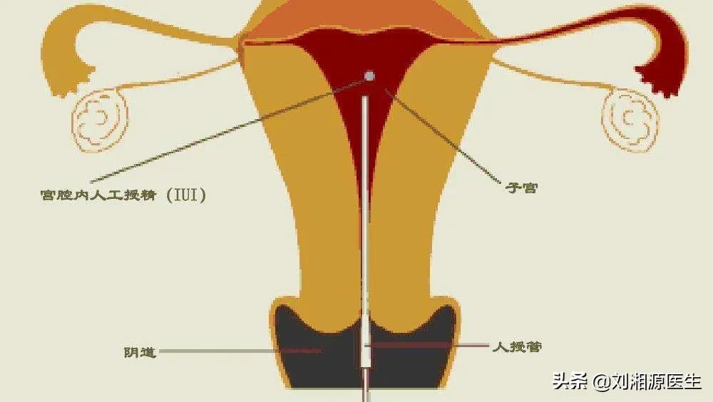 免疫相关高危妊娠,免疫性不良妊娠备孕