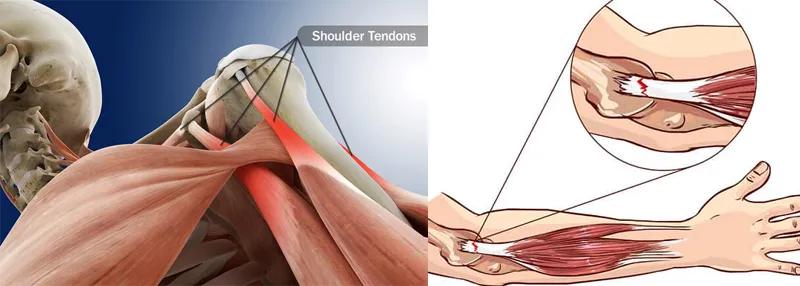 健身过度：当这种症状缠上你时，另外几种也离你不远了