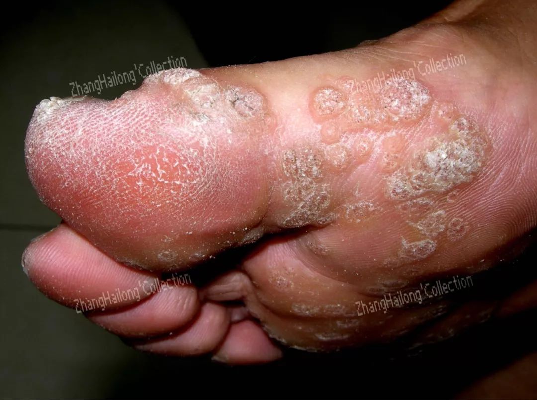 为什么会长瘊子,脚底为什么会长瘊子