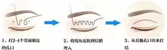 宝宝双眼皮消失的原因,做完全切双眼皮拉扯感多久会消失