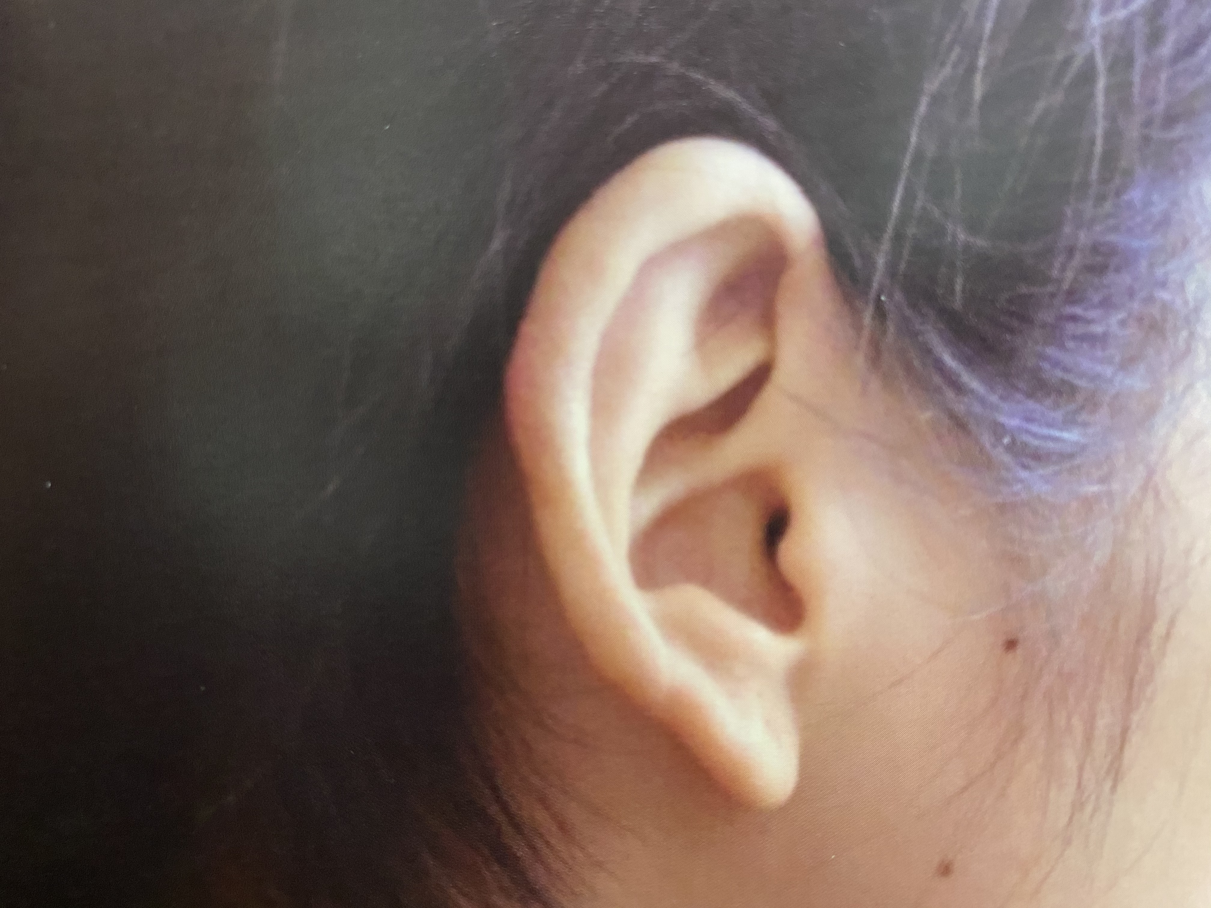 痤疮瘢痕疙瘩最新治疗方法,同位素治疗瘢痕疙瘩痊愈的过程