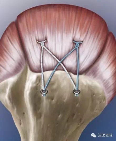 肩袖损伤要怎么处理,肩袖损伤专用膏药