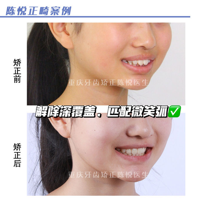 嘴凸深覆合可以自己矫正吗,上海牙齿龅牙矫正