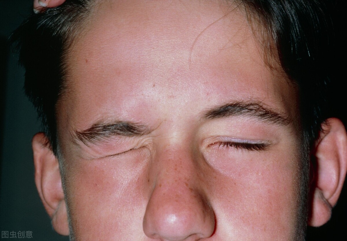 冬天面瘫的原因和治疗方法,预防寒冷刺激的面瘫吃什么药