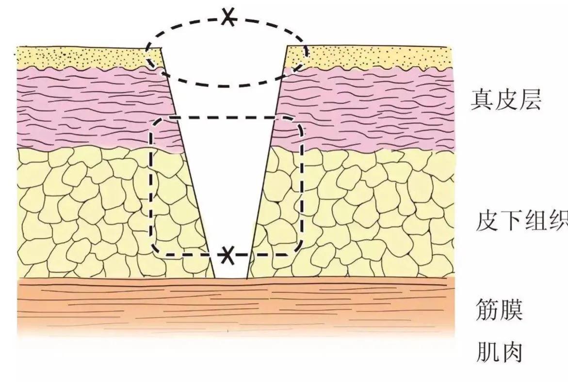 面部手术疤痕怎么能彻底消除,面部创伤缝合如何不留疤痕