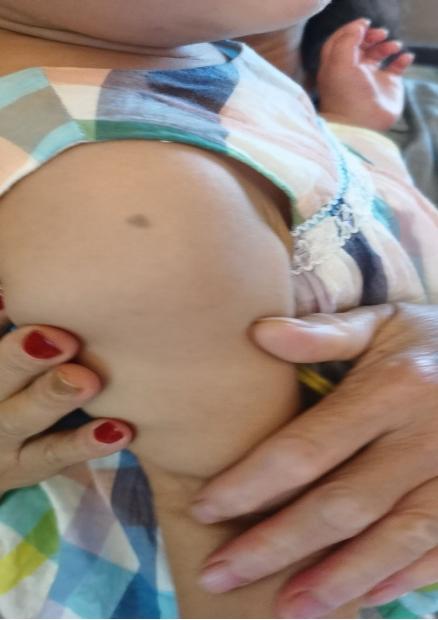 打完疫苗贴土豆片,打疫苗的地方疼可以贴土豆片吗