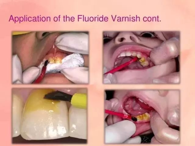 蛀牙下的牙龈有白色的小白点,牙齿有白斑是龋齿的前兆吗