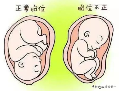 乾坤大挪移臀位变头位,臀位转头位乾坤大挪移多少周