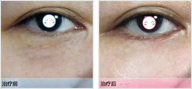 线雕热玛吉拉皮超声刀的区别,热玛吉超声刀线雕后遗症有多严重