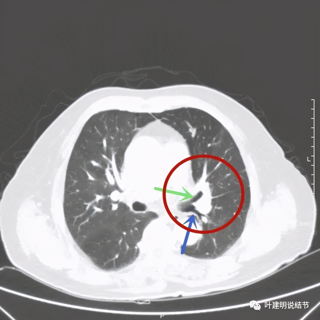 卡瑞利珠单抗治疗肺鳞癌有用吗,特瑞普利单抗对鳞癌治疗有效吗
